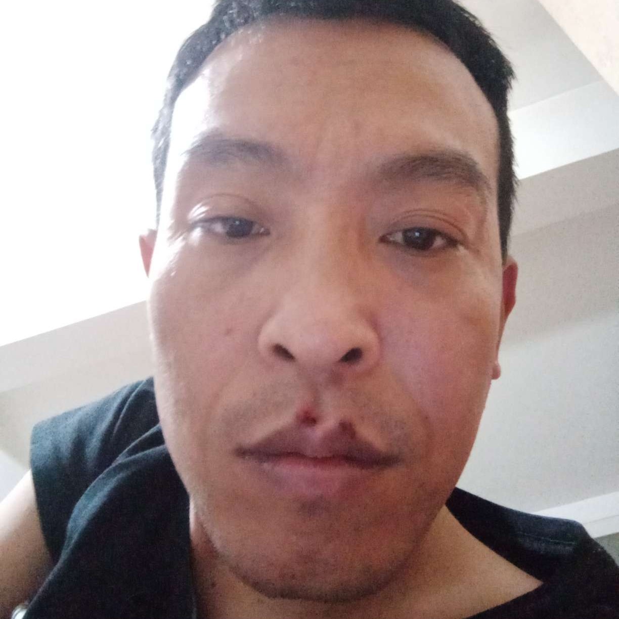 受伤邂逅蛋挞的照片